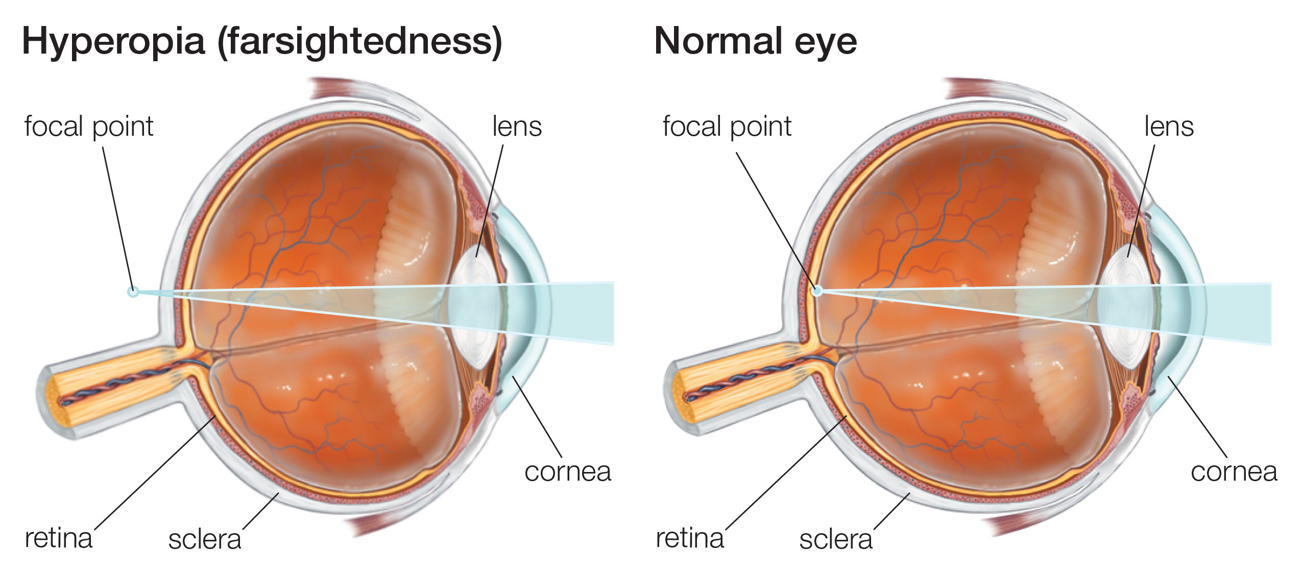 Hyperopia LaserVision Victoria